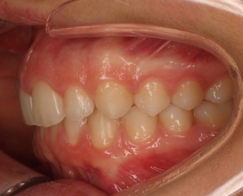 Cas real: ortodòncia invisible amb Invisalign