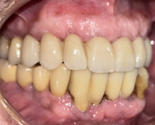 Rehabilitació oral superior amb implants i pròtesi fixa immediata